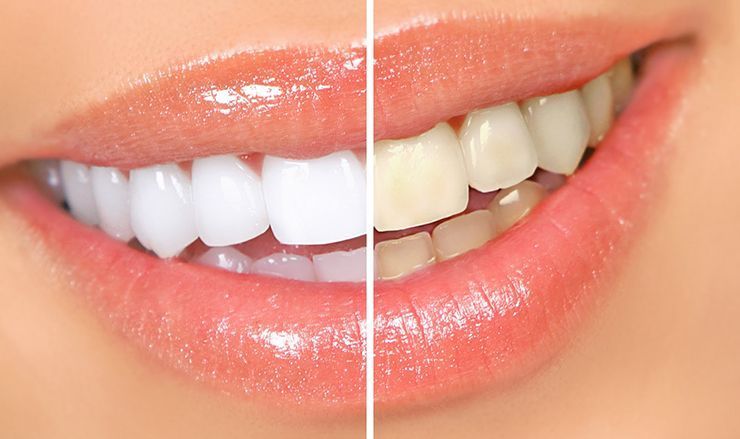 ¿Cuánto cuesta el blanqueamiento dental?